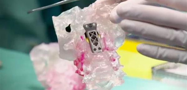 В Австралии больному раком спасли жизнь с помощью напечатанных на 3D-принтере позвонков - 1